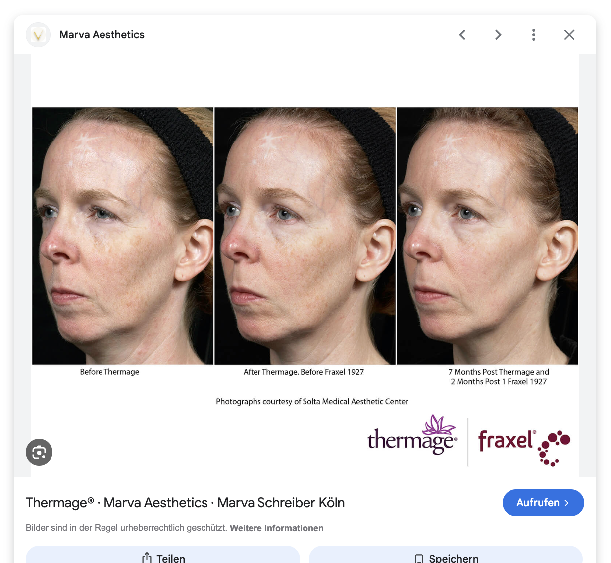 Gesicht, Wange & Jawline über mehrere Monate