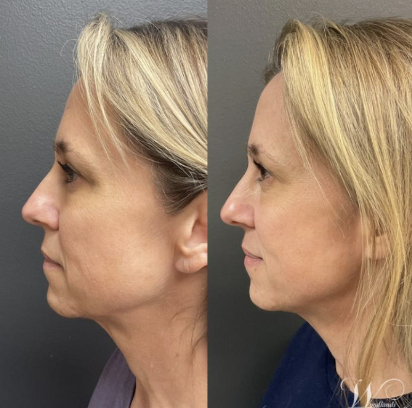 Jawline & unteres Gesicht, Profil — 180 Tage
